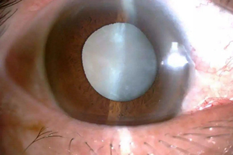 白内障瞳孔混浊图