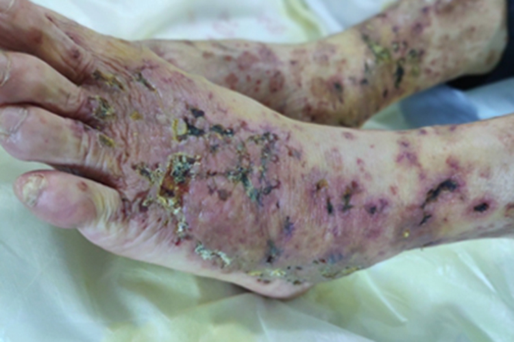 青斑性血管病脚背溃疡结痂图