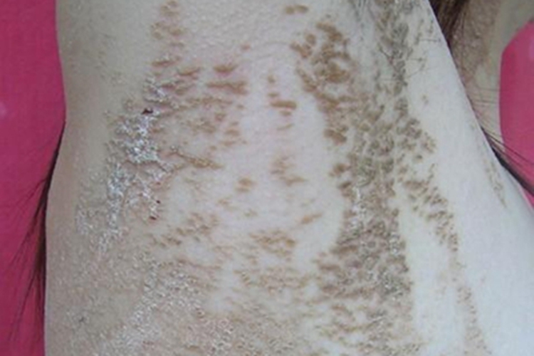 线状疣状表皮痣腋窝症状图