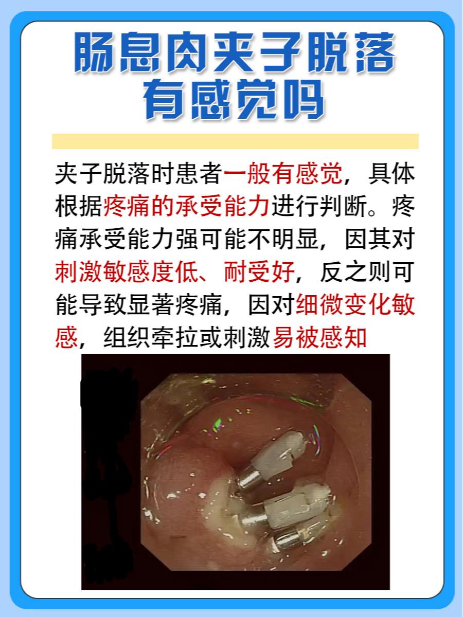 带你了解：肠息肉夹子脱落有感觉吗
