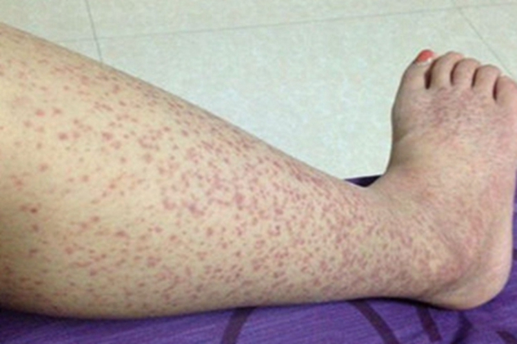 青霉素过敏小腿斑点图 青霉素过敏小腿斑点图