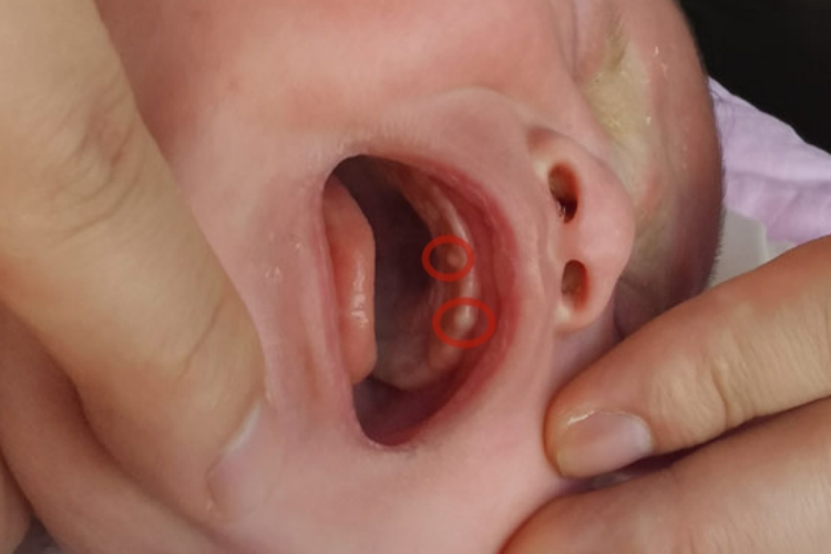 上颚小白点上皮珠图 上颚小白点上皮珠图