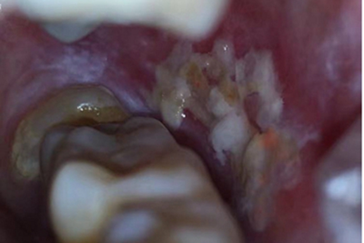 口腔白斑病口腔溃疡图