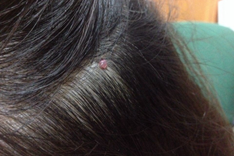 单发性有蒂软纤维瘤图 单发性有蒂软纤维瘤图