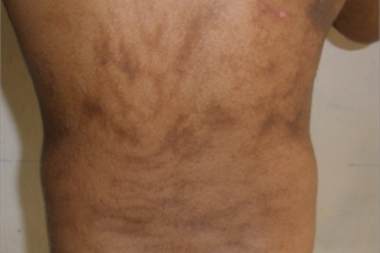 脱色性色素失禁症腰部条纹图