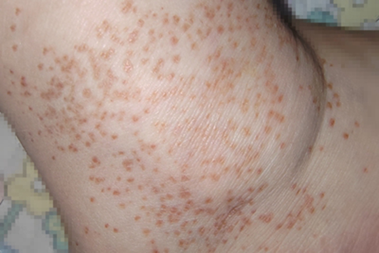 表皮痣脚踝长斑图