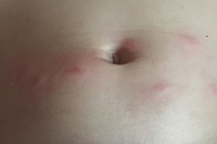 急性自发性荨麻疹肚脐图