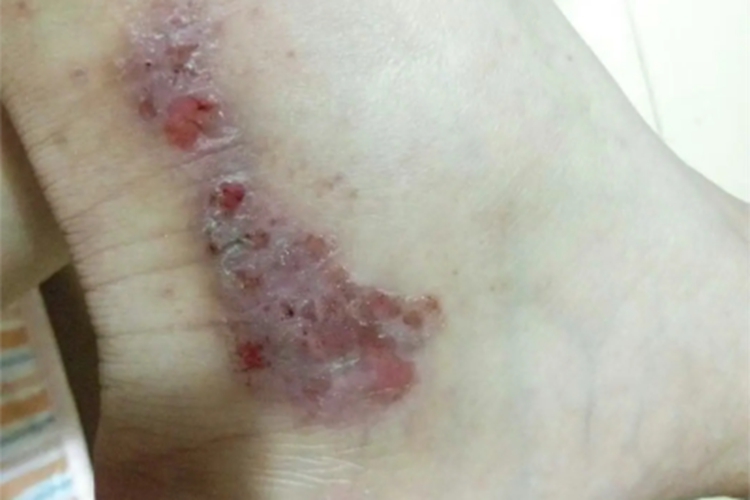 神经官能症性表皮剥脱脚踝糜烂图