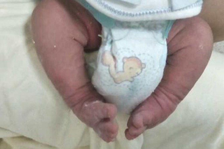 先天性多发性关节挛缩症畸形图