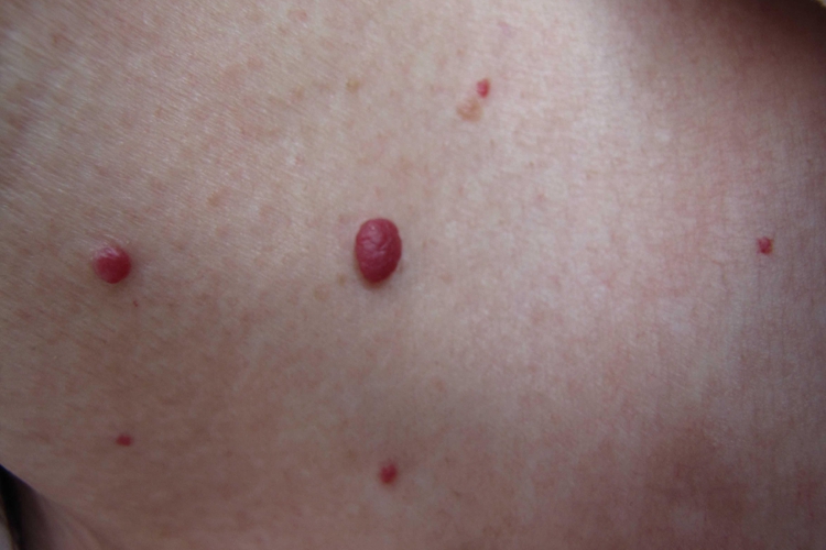 年轻人樱桃状血管瘤