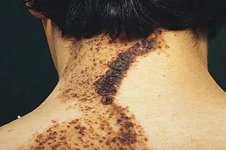 炎症型表皮痣症状图