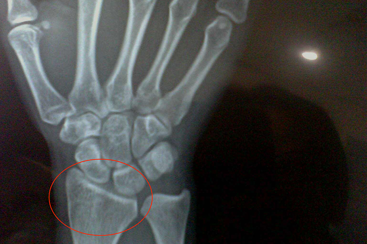 手腕骨骺闭合前图