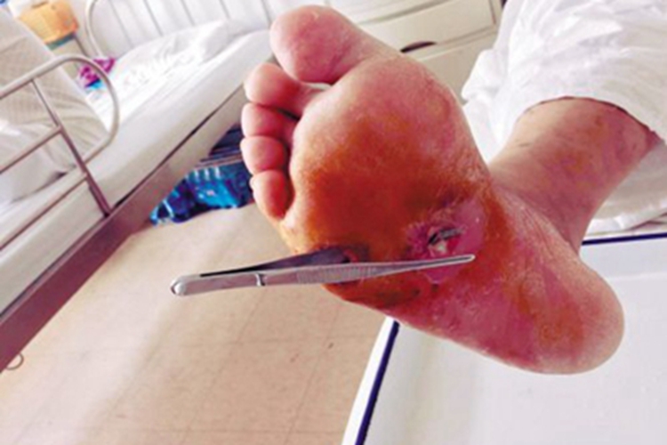 戳伤脚底症状图