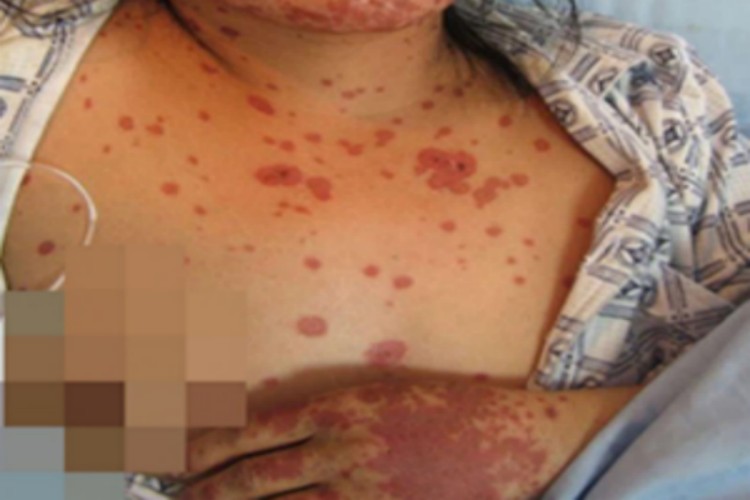 猩红热型药疹胸部症状图