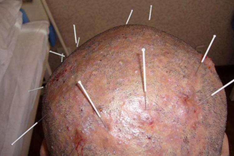 聚合性痤疮头皮有很多疙瘩图