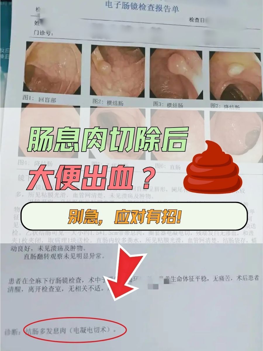 肠息肉切除后大便出血？别急，应对有招！