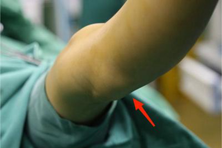 儿童腘窝囊肿有囊肿图