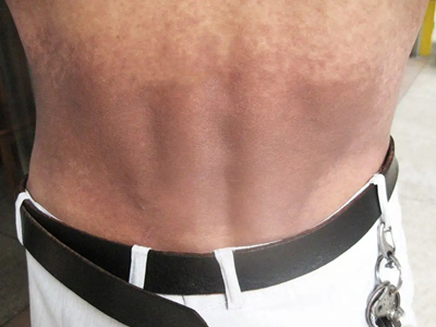 黑变病患者腰部可出现大面积棕褐色的斑片,中间颜色较深,密度均匀