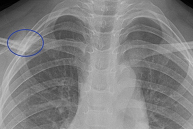 锁骨骨折畸形愈合X线片图