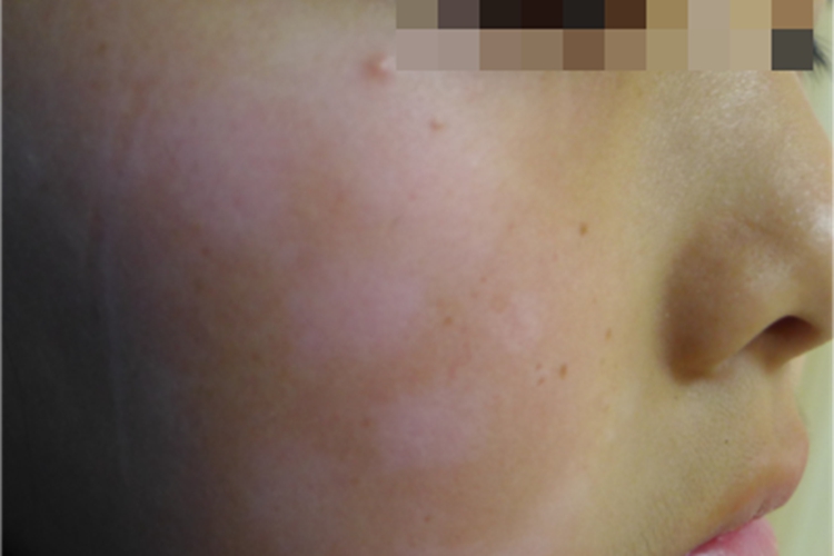 进展期节段型白癜风面部白斑图