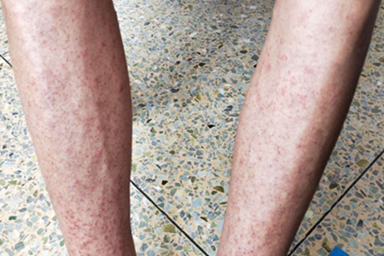 机械性紫癜小腿红点图