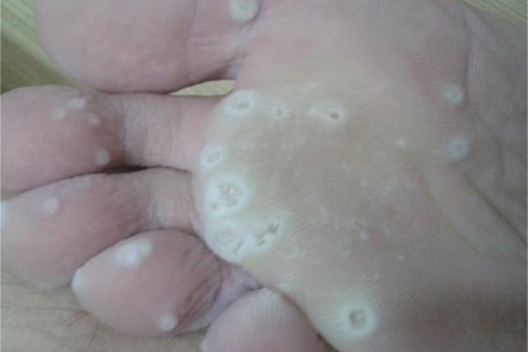 硬鸡眼前脚掌有黄色硬疙瘩图