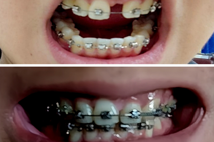 正畸拔上门牙效果图