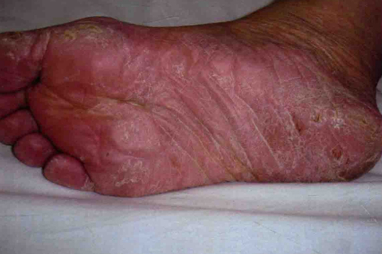 浸渍糜烂型足癣图