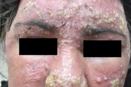 玫瑰痤疮严重图 玫瑰痤疮严重图