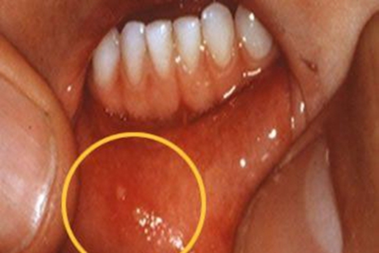 手足口病唇内侧起小水疱图