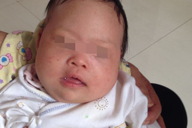 唐氏综合征婴儿伸舌头图