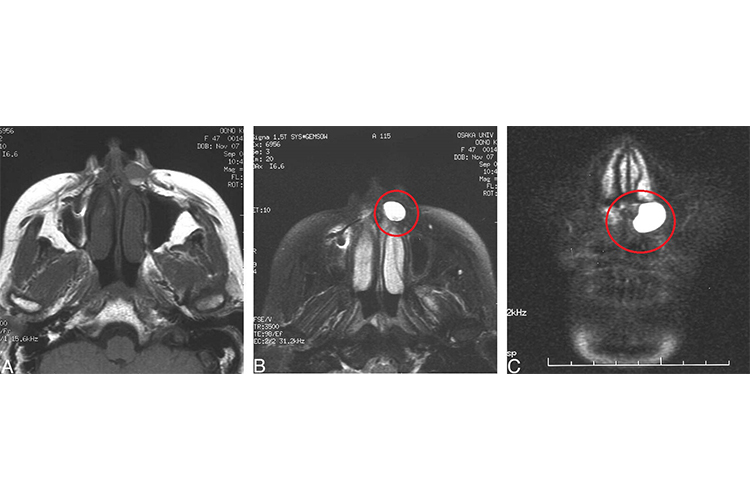 鼻前庭囊肿影像图