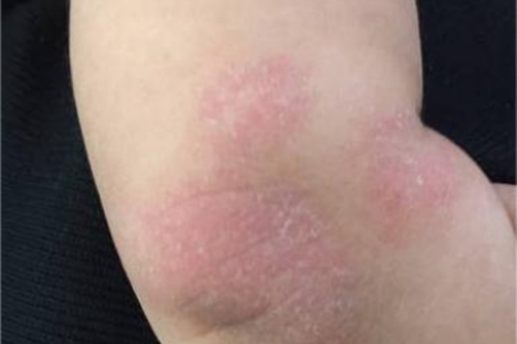 婴儿期特应性皮炎肘部症状图