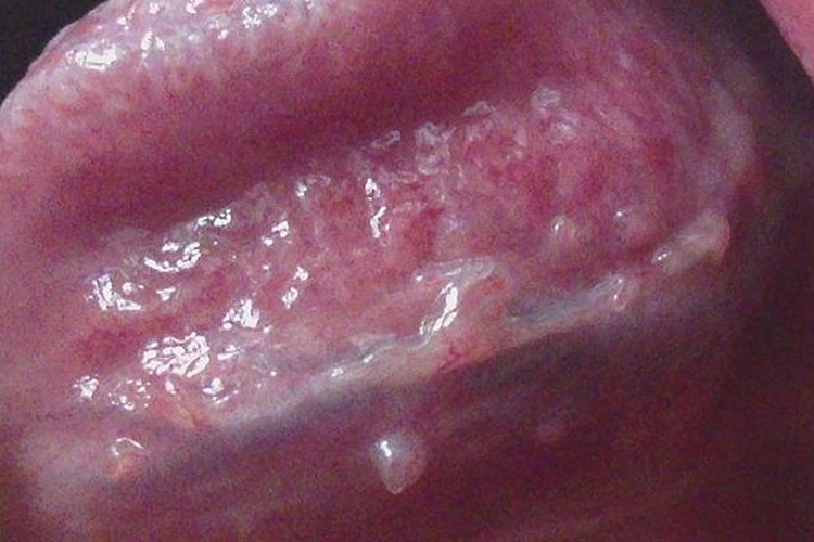 舌系带尖锐湿疣图