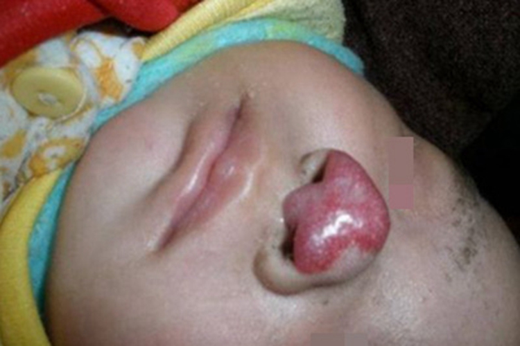 混合型婴儿血管瘤鼻尖红斑图 混合型婴儿血管瘤鼻尖红斑图