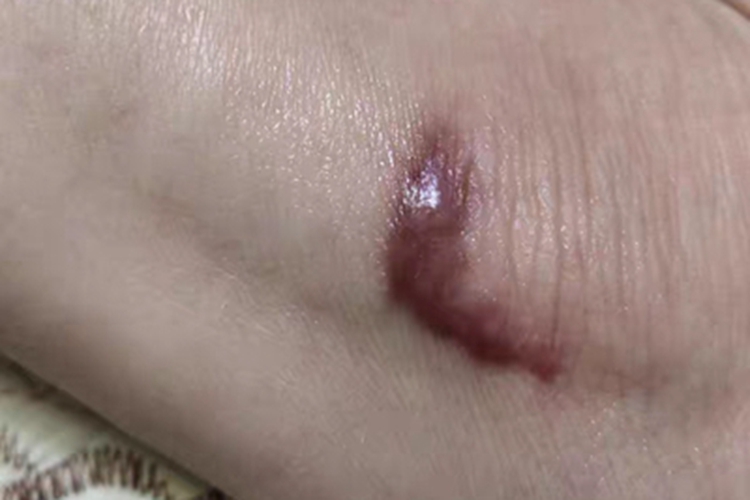 瘢痕疙瘩小腿疙瘩图