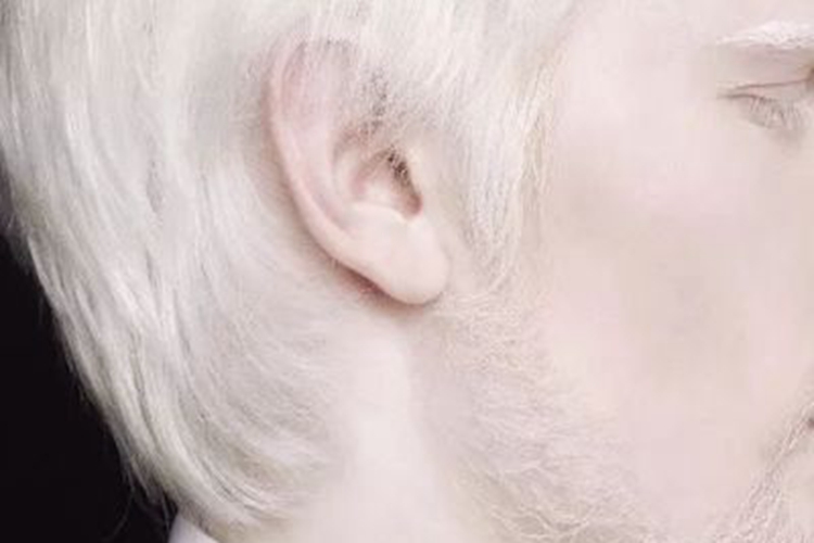 眼皮肤白化病毛发变白图