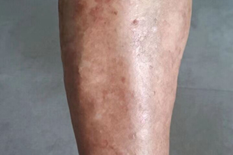 体癣小腿皮肤颜色加深图 体癣小腿皮肤颜色加深图