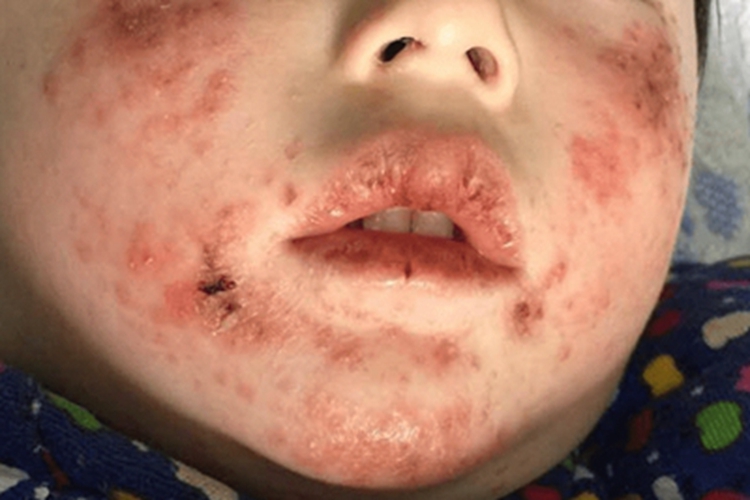 脓疱疮面部溃疡图