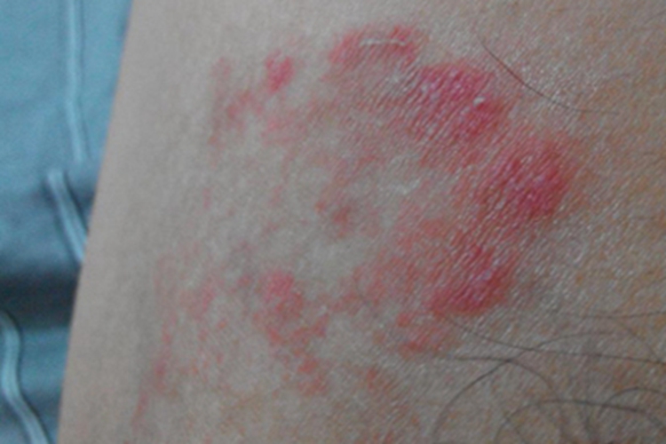 大腿内侧湿疹图