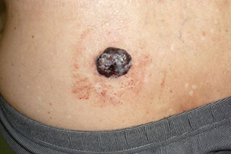 结节型黑色素瘤腰部溃疡图 结节型黑色素瘤腰部溃疡图