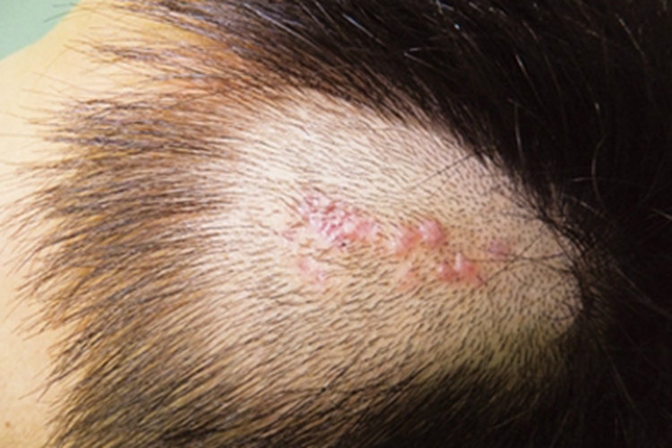 乳头状汗管囊腺瘤头皮丘疹图 乳头状汗管囊腺瘤头皮丘疹图