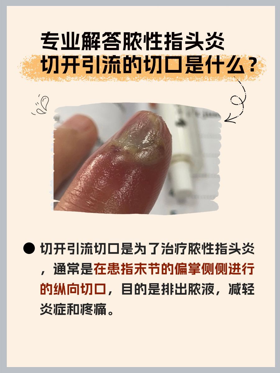 专业解答脓性指头炎切开引流的切口是什么？