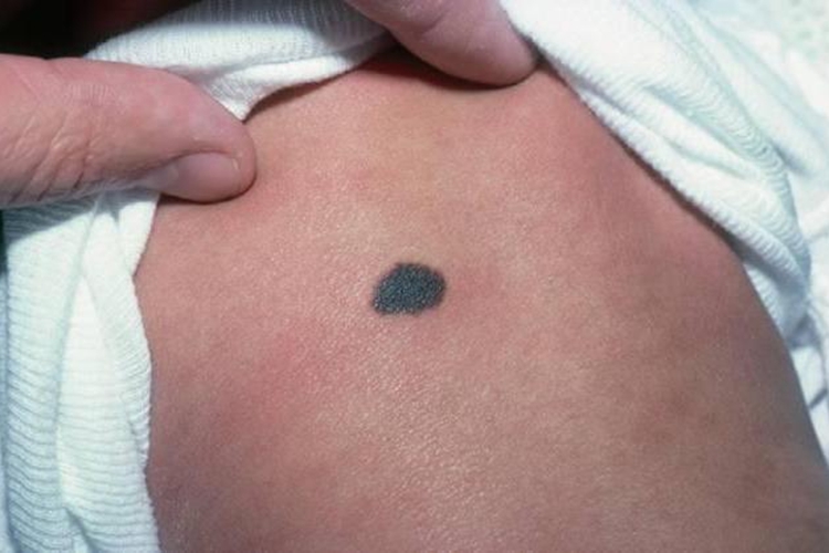 色素痣图