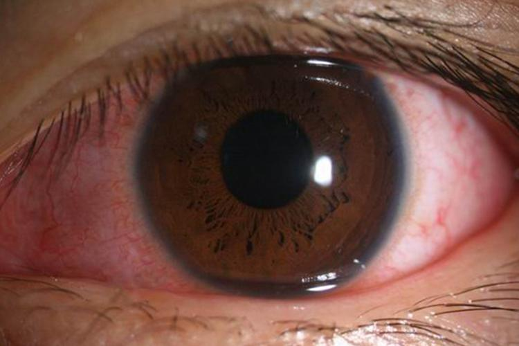 结膜炎眼部充血图