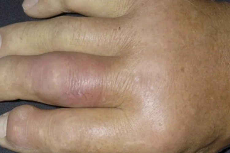 蜂窝织炎手指发红图