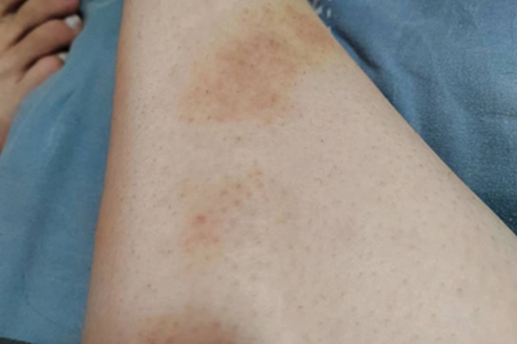 急性湿疹小腿斑图