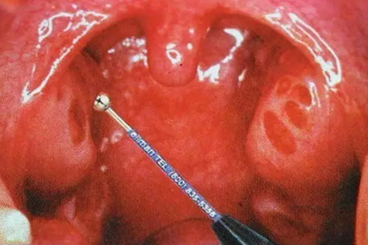 咽旁脓肿图 咽旁脓肿图