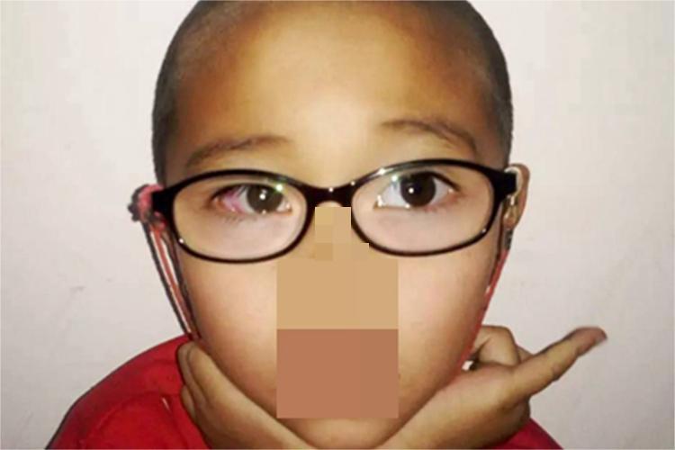 狭颅症眼部症状图