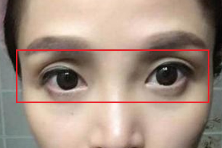 营养不良眼窝凹陷图 营养不良眼窝凹陷图